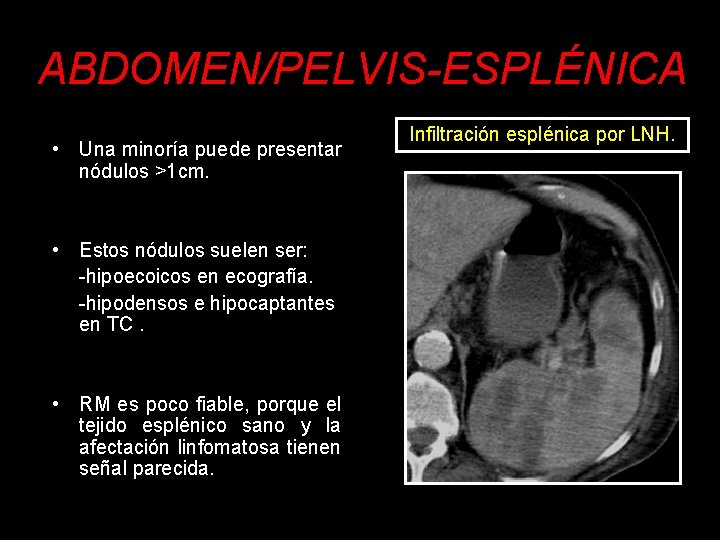 ABDOMEN/PELVIS-ESPLÉNICA • Una minoría puede presentar nódulos >1 cm. Infiltración esplénica por LNH. •