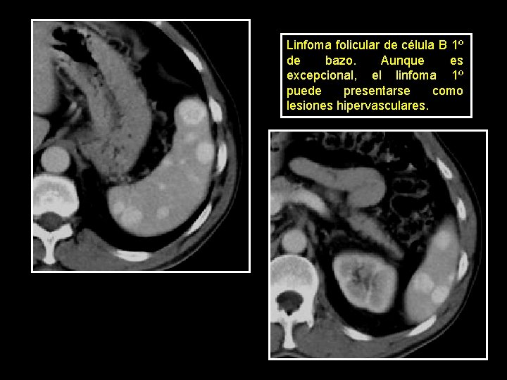 Linfoma folicular de célula B 1º de bazo. Aunque es excepcional, el linfoma 1º
