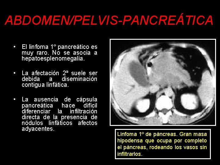 ABDOMEN/PELVIS-PANCREÁTICA • El linfoma 1º pancreático es muy raro. No se asocia a hepatoesplenomegalia.