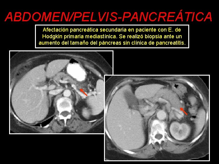 ABDOMEN/PELVIS-PANCREÁTICA Afectación pancreática secundaria en paciente con E. de Hodgkin primaria mediastínica. Se realizó