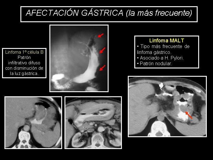 AFECTACIÓN GÁSTRICA (la más frecuente) Linfoma MALT • Tipo más frecuente de linfoma gástrico.