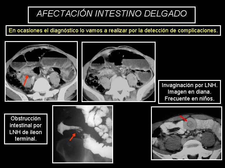 AFECTACIÓN INTESTINO DELGADO En ocasiones el diagnóstico lo vamos a realizar por la detección