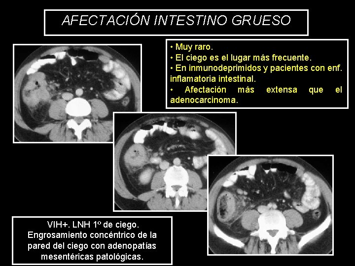 AFECTACIÓN INTESTINO GRUESO • Muy raro. • El ciego es el lugar más frecuente.