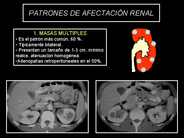PATRONES DE AFECTACIÓN RENAL 1. MASAS MÚLTIPLES • Es el patrón más común, 60