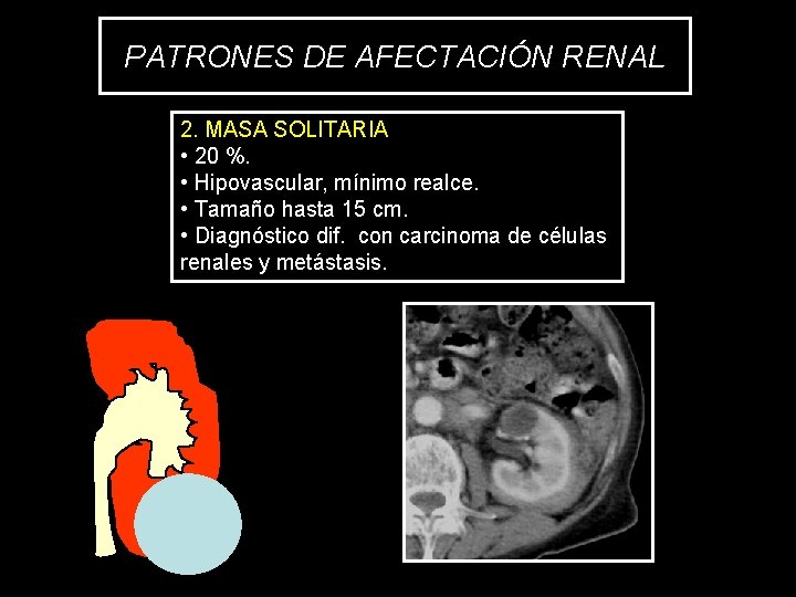 PATRONES DE AFECTACIÓN RENAL 2. MASA SOLITARIA • 20 %. • Hipovascular, mínimo realce.