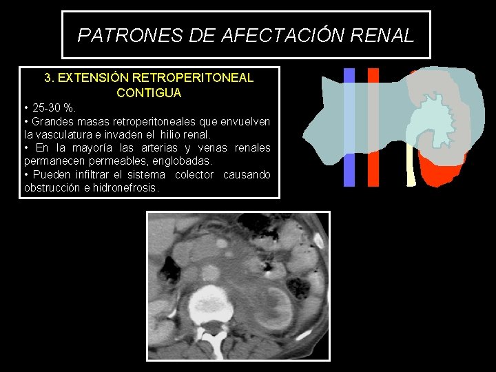 PATRONES DE AFECTACIÓN RENAL 3. EXTENSIÓN RETROPERITONEAL CONTIGUA • 25 -30 %. • Grandes
