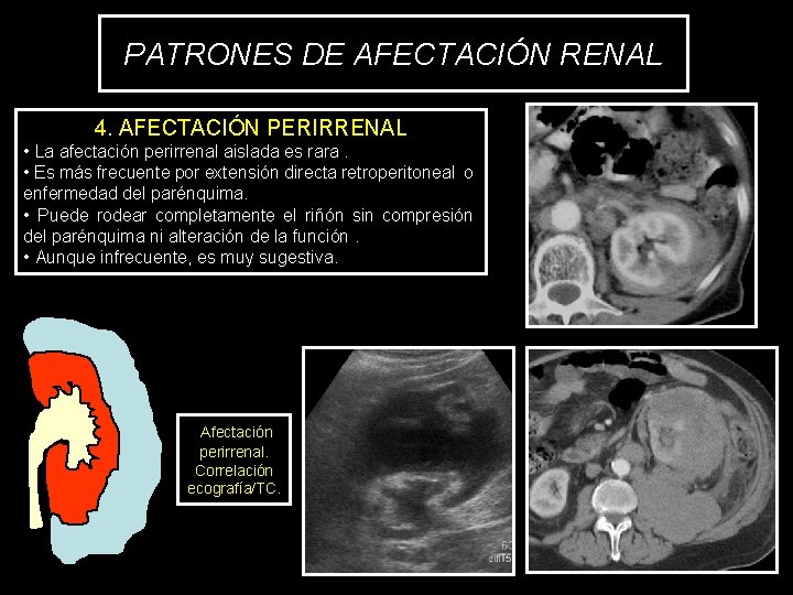 PATRONES DE AFECTACIÓN RENAL 4. AFECTACIÓN PERIRRENAL • La afectación perirrenal aislada es rara.
