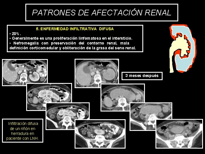 PATRONES DE AFECTACIÓN RENAL 5. ENFERMEDAD INFILTRATIVA DIFUSA • 20%. • Generalmente es una