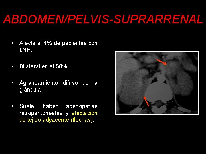 ABDOMEN/PELVIS-SUPRARRENAL • Afecta al 4% de pacientes con LNH. • Bilateral en el 50%.