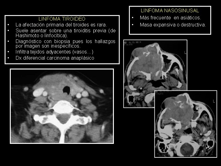  • • • LINFOMA TIROIDEO La afectación primaria del tiroides es rara. Suele