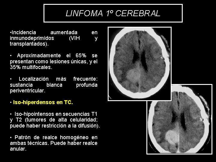 LINFOMA 1º CEREBRAL • Incidencia aumentada inmunodeprimidos (VIH transplantados). en y • Aproximadamente el