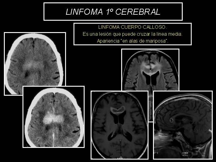 LINFOMA 1º CEREBRAL LINFOMA CUERPO CALLOSO. Es una lesión que puede cruzar la linea