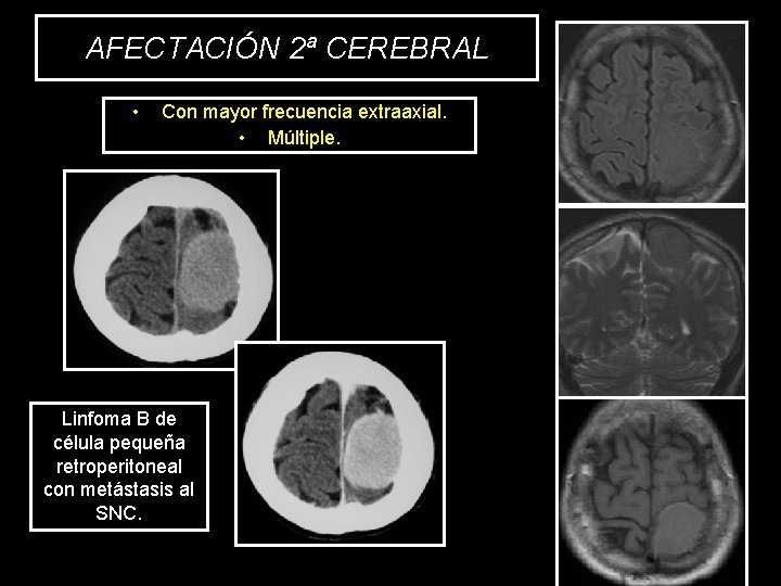 AFECTACIÓN 2ª CEREBRAL • Con mayor frecuencia extraaxial. • Múltiple. Linfoma B de célula