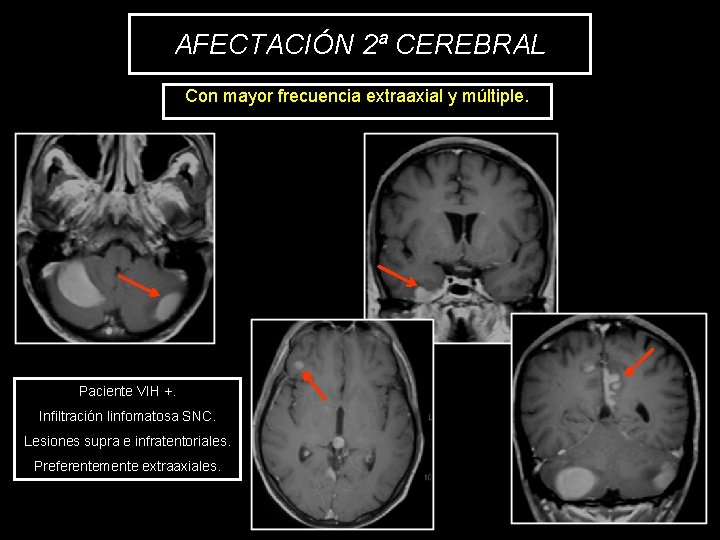 AFECTACIÓN 2ª CEREBRAL Con mayor frecuencia extraaxial y múltiple. Paciente VIH +. Infiltración linfomatosa