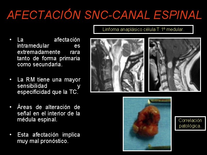 AFECTACIÓN SNC-CANAL ESPINAL Linfoma anaplásico célula T 1º medular. • La afectación intramedular es