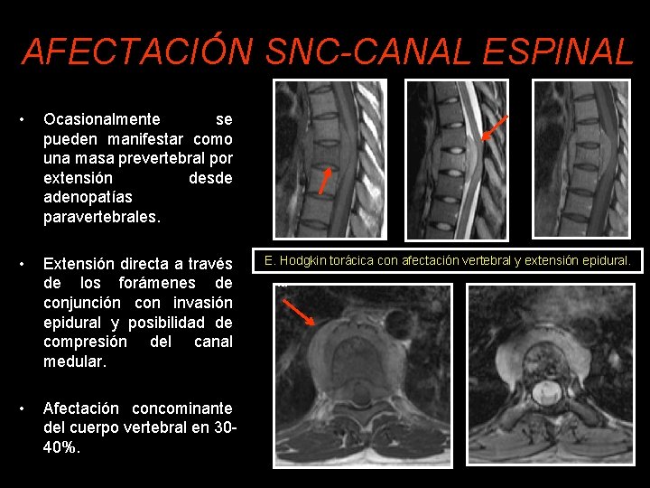 AFECTACIÓN SNC-CANAL ESPINAL • Ocasionalmente se pueden manifestar como una masa prevertebral por extensión