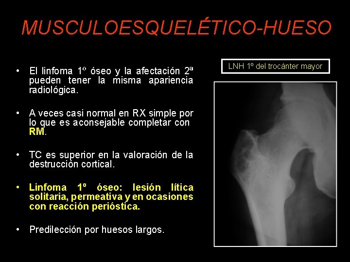 MUSCULOESQUELÉTICO-HUESO • El linfoma 1º óseo y la afectación 2ª pueden tener la misma