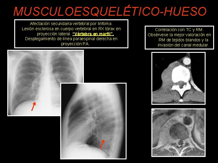 MUSCULOESQUELÉTICO-HUESO Afectación secundaria vertebral por linfoma. Lesión esclerosa en cuerpo vertebral en RX tórax