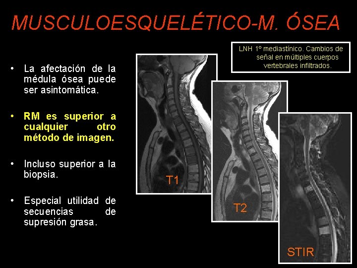 MUSCULOESQUELÉTICO-M. ÓSEA LNH 1º mediastínico. Cambios de señal en múltiples cuerpos vertebrales infiltrados. •