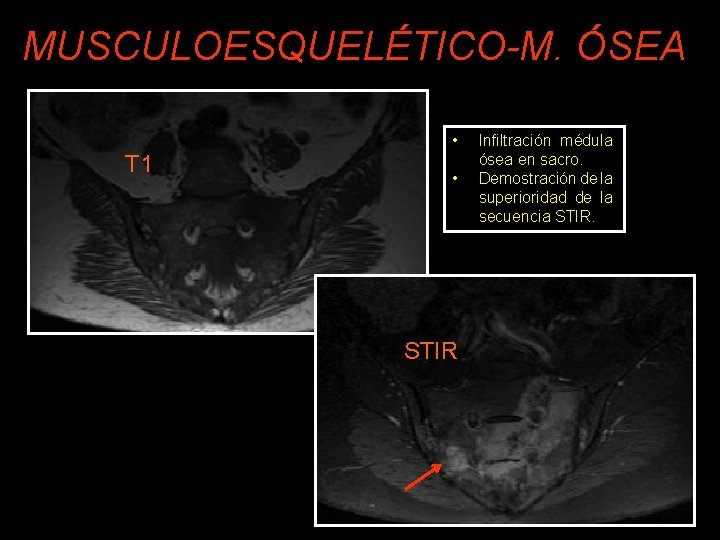 MUSCULOESQUELÉTICO-M. ÓSEA • T 1 • STIR Infiltración médula ósea en sacro. Demostración de