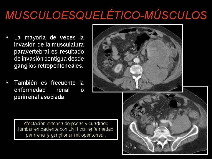 MUSCULOESQUELÉTICO-MÚSCULOS • La mayoría de veces la invasión de la musculatura paravertebral es resultado