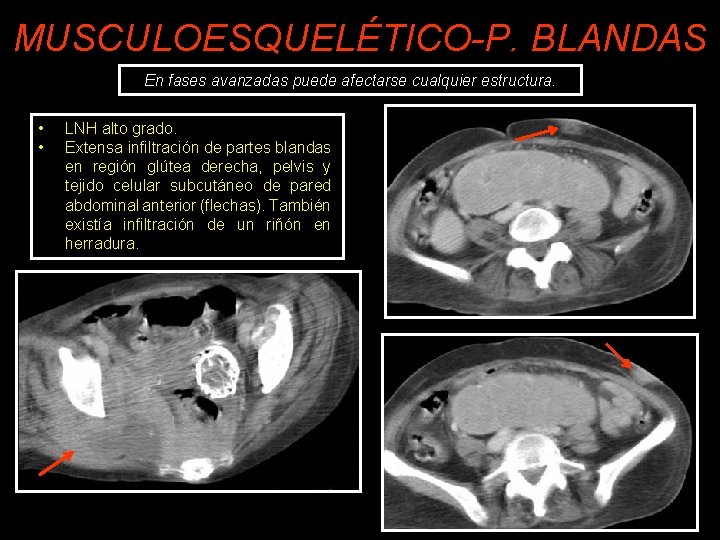 MUSCULOESQUELÉTICO-P. BLANDAS En fases avanzadas puede afectarse cualquier estructura. • • LNH alto grado.