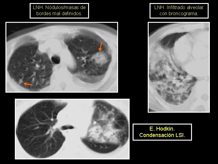 LNH. Nódulos/masas de bordes mal definidos. LNH. Infiltrado alveolar con broncograma. E. Hodkin. Condensación