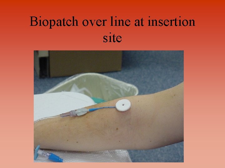 Biopatch over line at insertion site 