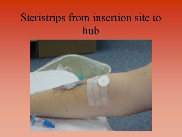 Steristrips from insertion site to hub 