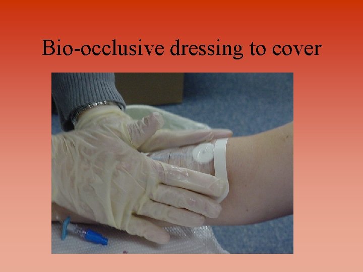 Bio-occlusive dressing to cover 