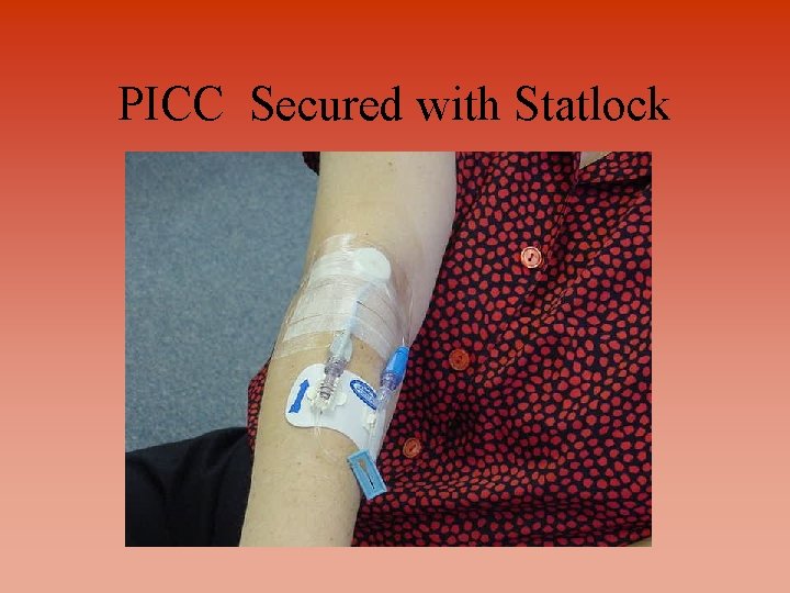 PICC Secured with Statlock 