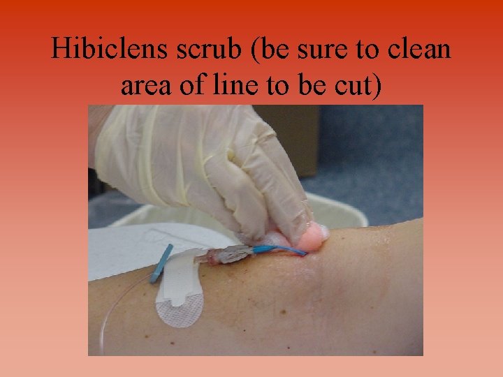 Hibiclens scrub (be sure to clean area of line to be cut) 