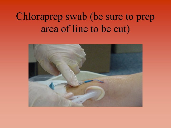 Chloraprep swab (be sure to prep area of line to be cut) 