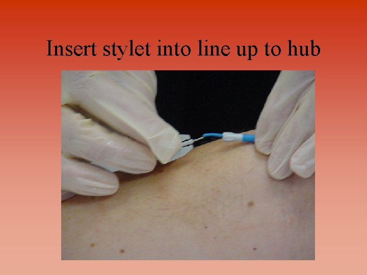 Insert stylet into line up to hub 