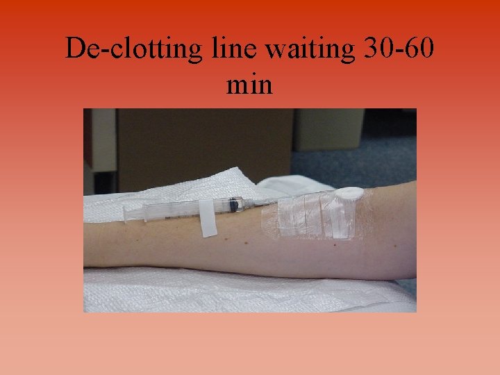 De-clotting line waiting 30 -60 min 