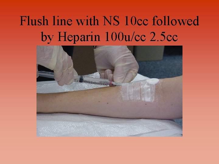 Flush line with NS 10 cc followed by Heparin 100 u/cc 2. 5 cc