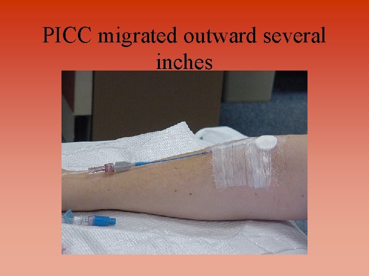 PICC migrated outward several inches 