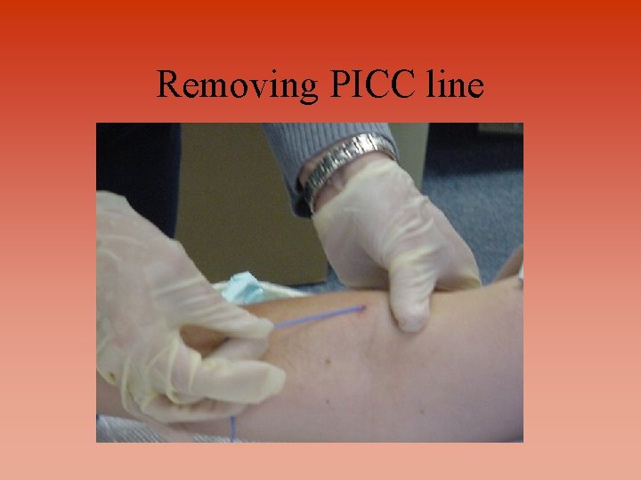 Removing PICC line 