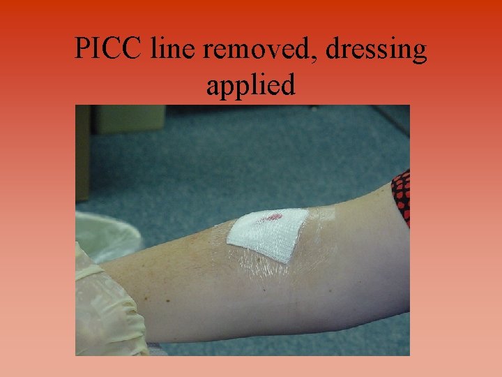 PICC line removed, dressing applied 