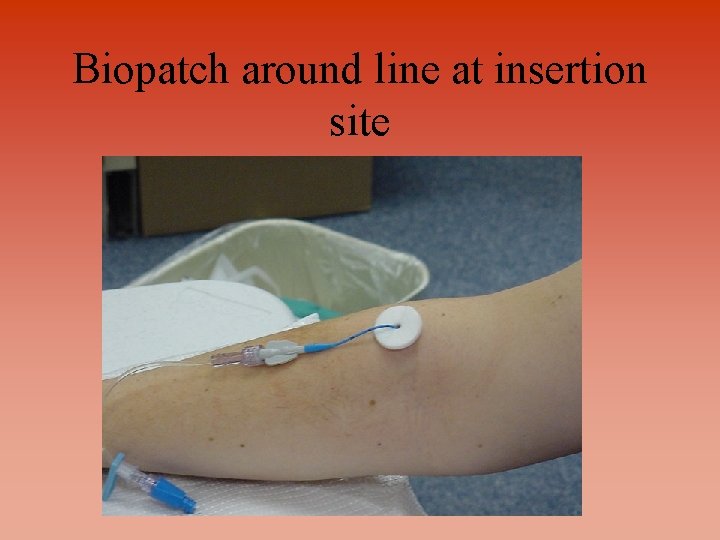 Biopatch around line at insertion site 