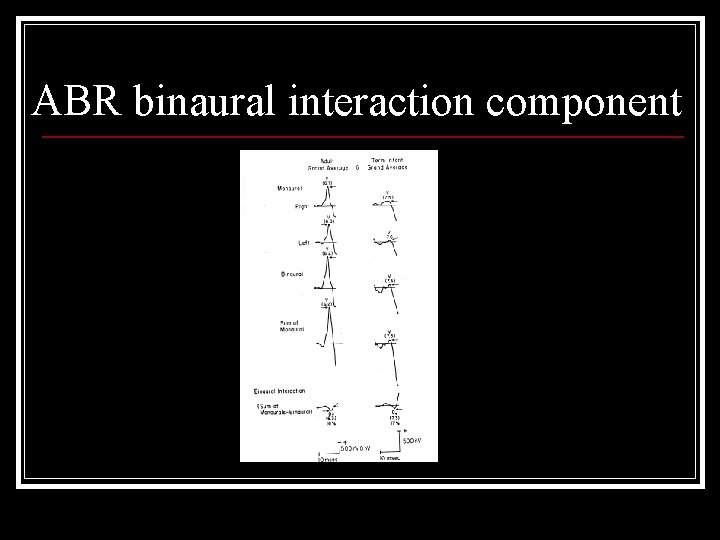 ABR binaural interaction component 