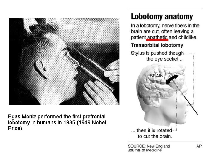 Egas Moniz performed the first prefrontal lobotomy in humans in 1935. (1949 Nobel Prize)