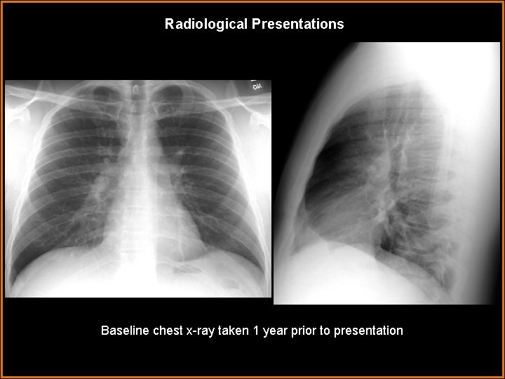 Radiological Presentations Baseline chest x-ray taken 1 year prior to presentation 
