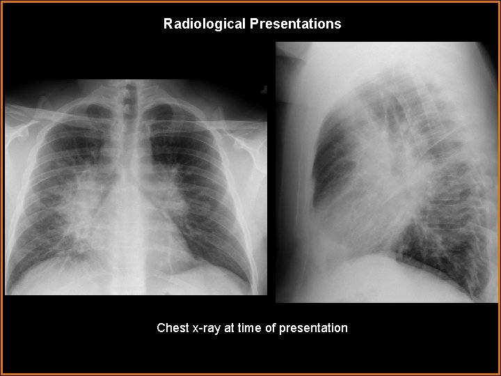 Radiological Presentations Chest x-ray at time of presentation 