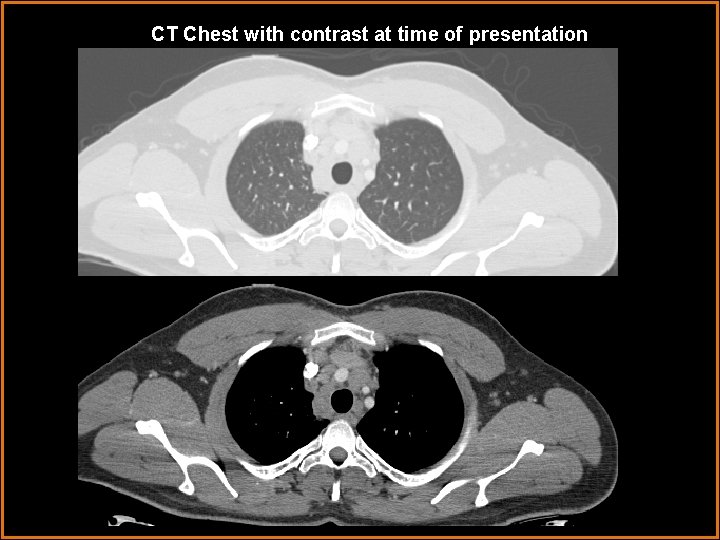 CT Chest with contrast at time of presentation 