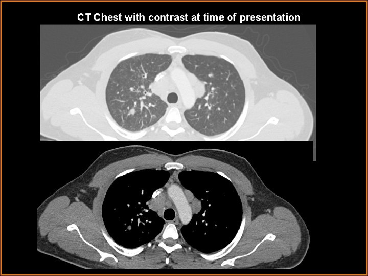 CT Chest with contrast at time of presentation 