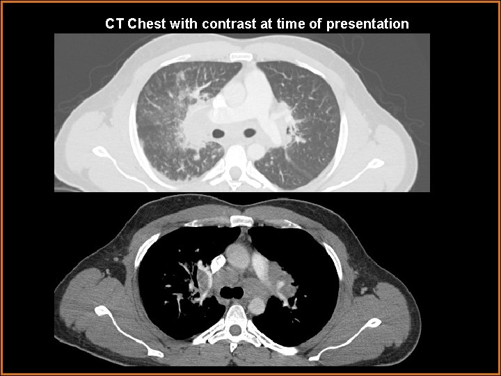 CT Chest with contrast at time of presentation 