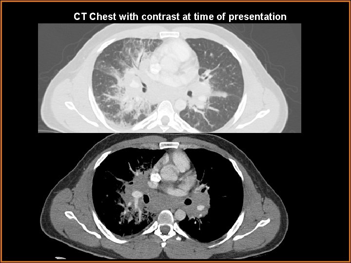 CT Chest with contrast at time of presentation 