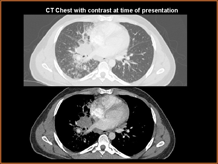 CT Chest with contrast at time of presentation 