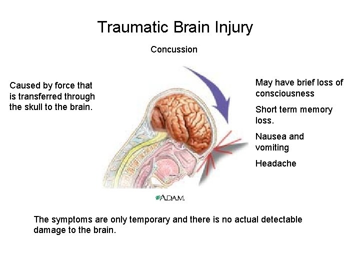Traumatic Brain Injury Concussion Caused by force that is transferred through the skull to